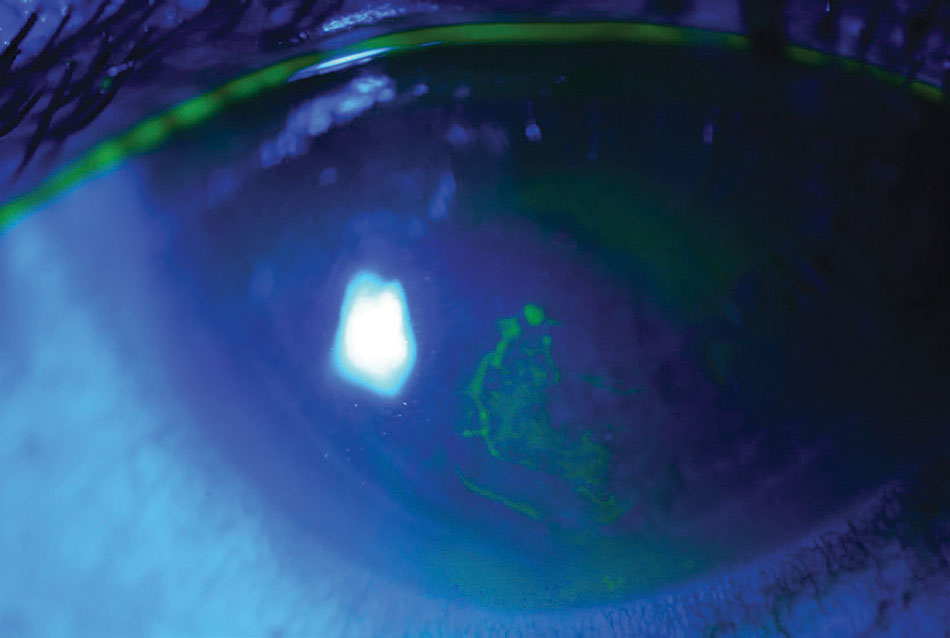 Since RCE syndrome is the result of abnormal adhesion of the corneal epithelium to the epithelial basement membrane, surgical interventions can remove the unstable epithelium and PTK can provide a greater stability and stronger epithelial anchorage.