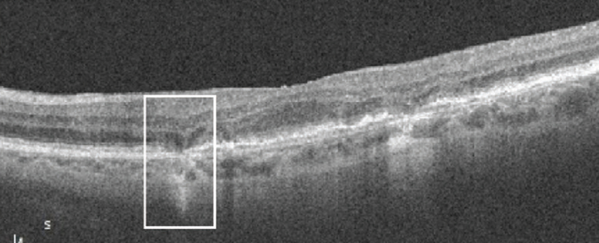 Researchers identified the following four imaging predictors of late-stage AMD development, from most to least significant: iRORA (seen here, white box), EZ status, drusen area and presence of hyperreflective foci. 