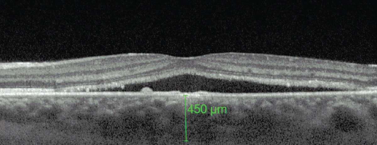 A thicker-than-average choroid is characteristic of CSCR.