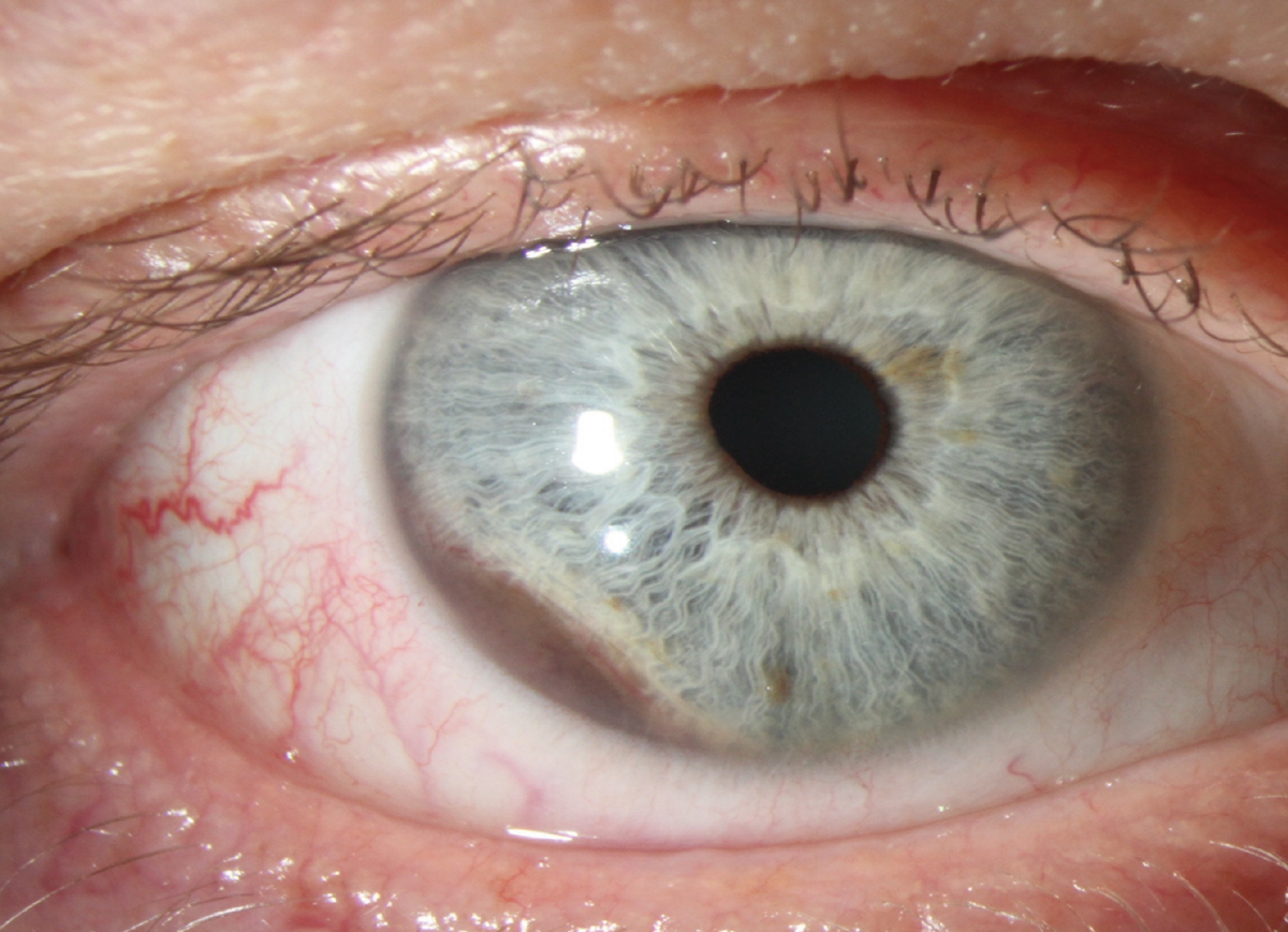 Fig. 1. A different patient than the case presented; note the blue eyes. A ciliary body malignant melanoma is invading the iris from seven to nine o’clock OD. Possible sentinel vessels at nine o’clock secondary to a ciliary body malignant melanoma below. Could this lesion be missed if this patient had dark brown eyes?
