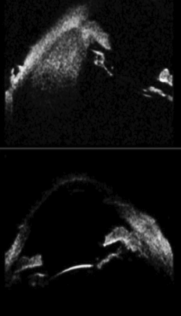 Fig. 2. Two UBM sections of the anterior segment. At eight o’clock (top image) is the ciliary body malignant melanoma. The section through 10 and four o’clock (bottom image) does not reveal any gross abnormality.