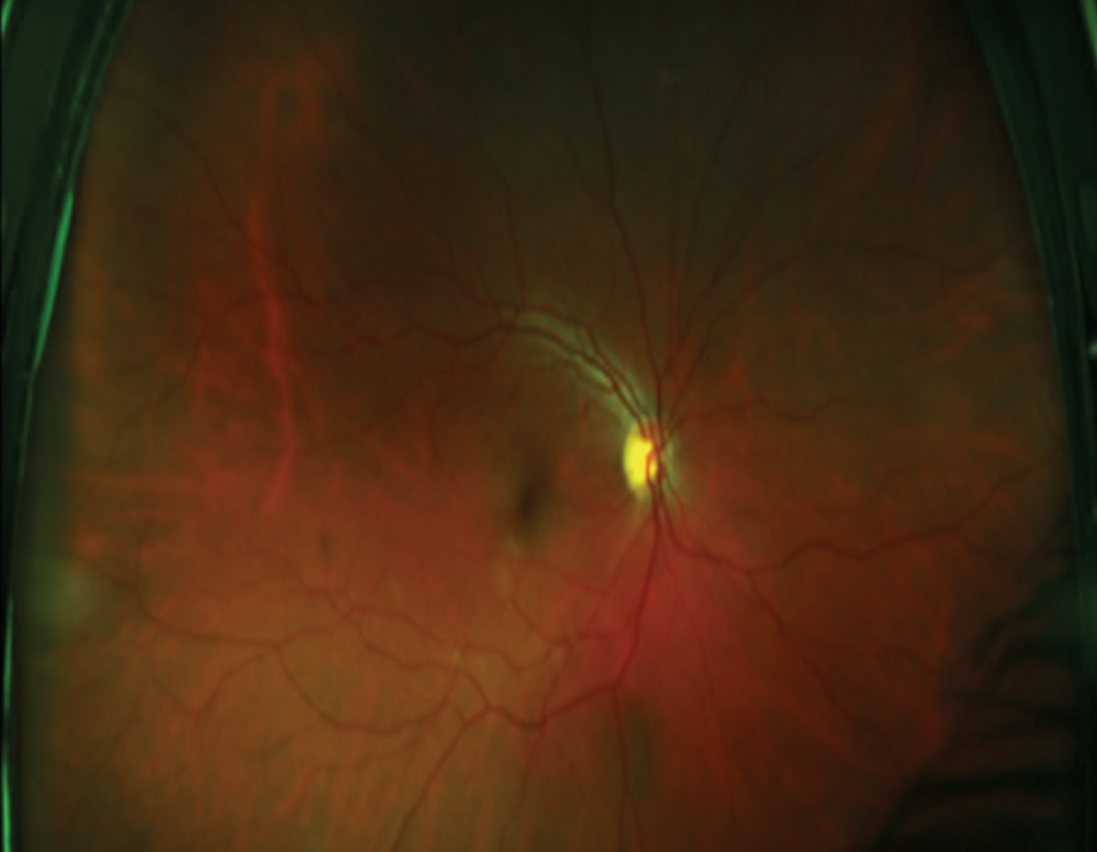 Fig. 3. Optos ultrawidefield image OD about a year prior to the diagnosis. Is the subtle peripheral dark zone between between eight and 10 o’clock normal or an early choroidal melanoma?