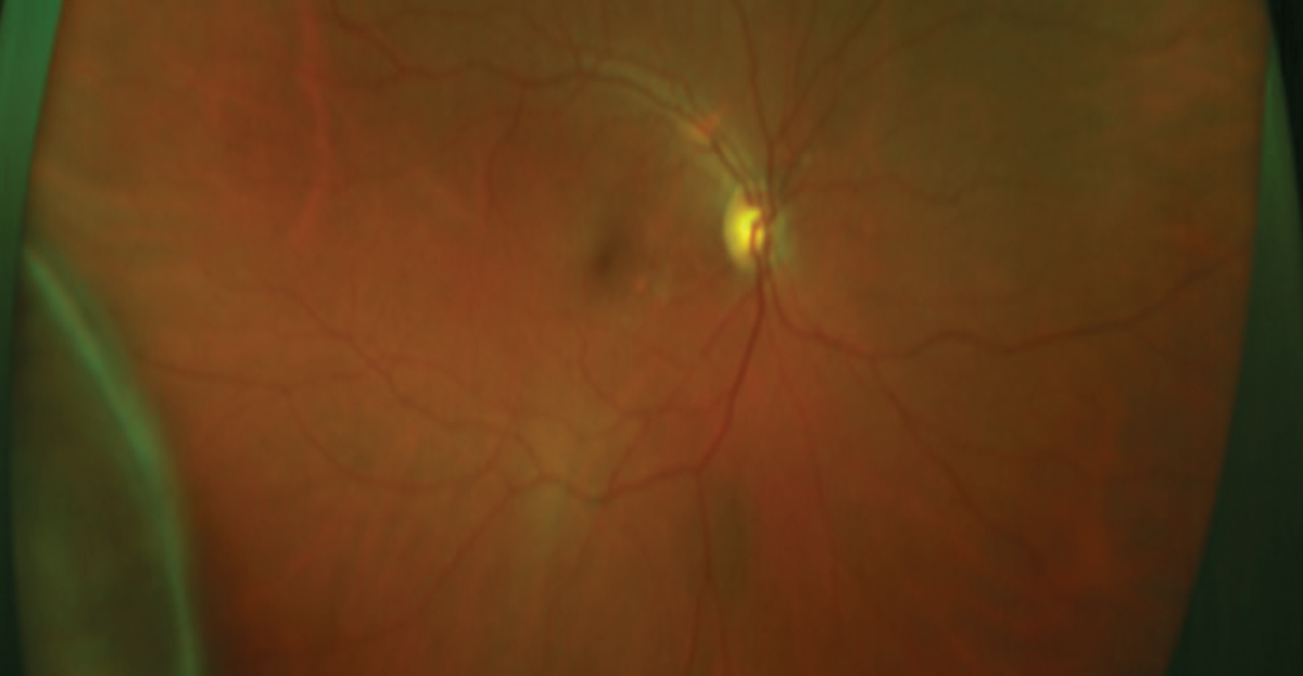 Fig 4. The lesion between seven and nine o’clock is a choroidal melanoma, which is the posterior extension of the ciliary body malignant melanoma.