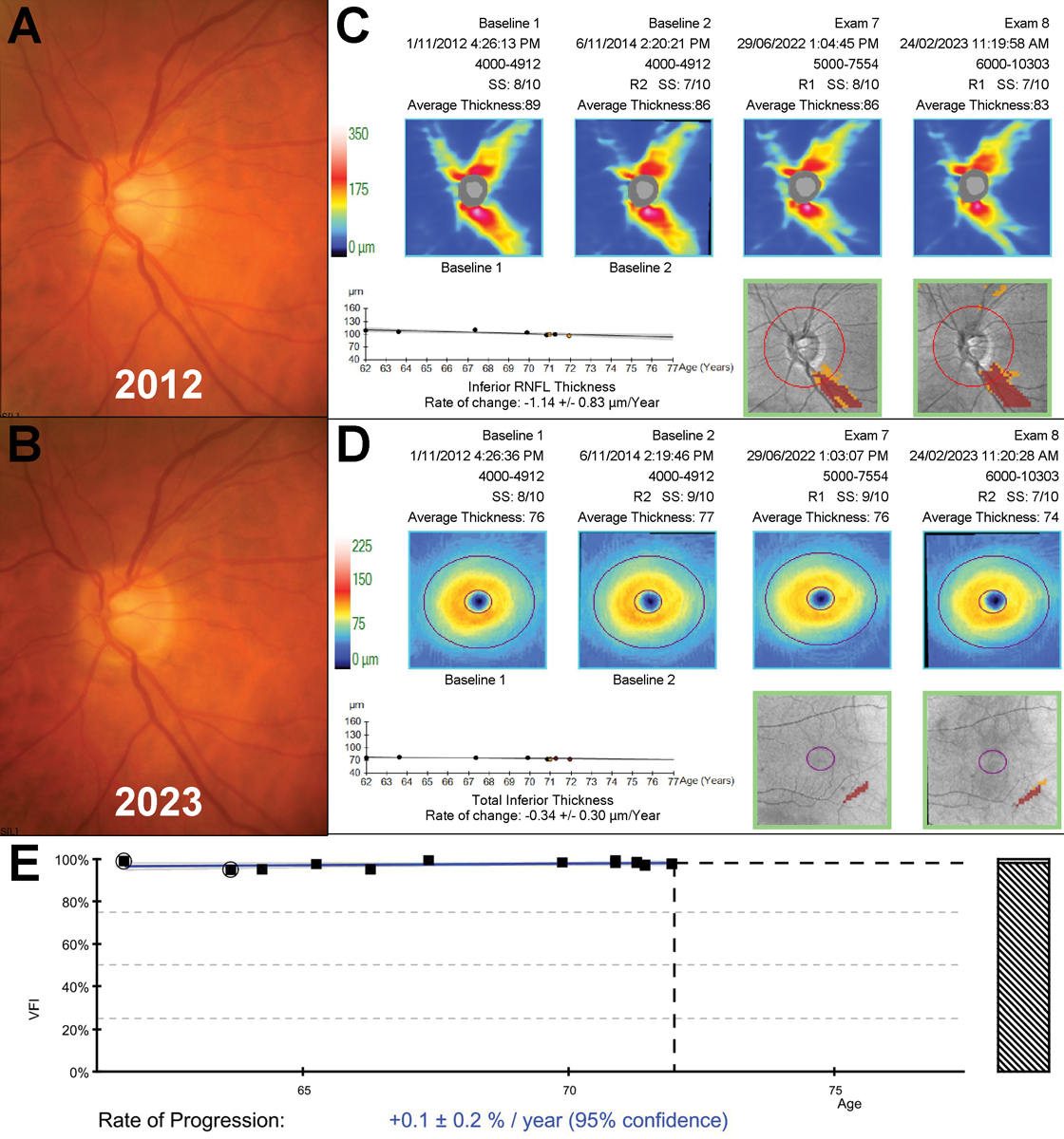 Fig. 2. An example of a 72-year-old patient with slow progressing untreated normal tension glaucoma monitored over an 11-year period. A to B: Fundus photographs showed subtle thinning of the inferior neuroretinal rim between 2012 and 2023. C to D: Structural progression analyses showed slow inferior thinning on both the RNFL and ganglion cell-inner plexiform layer printouts. E: VF index progression analysis showed no evidence of associated functional deterioration. 