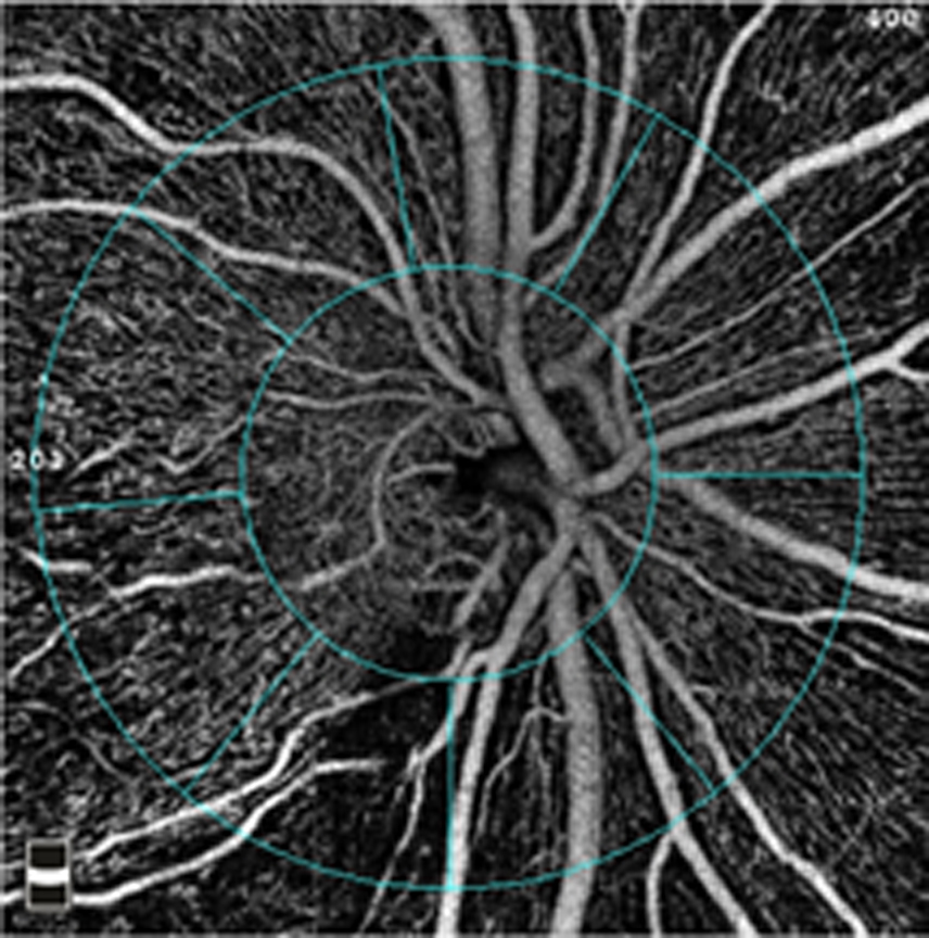 Fig. 4. By monitoring blood flow within the retina, OCT-A provides a way to assess the health of the ganglion cells that are affected in glaucoma.