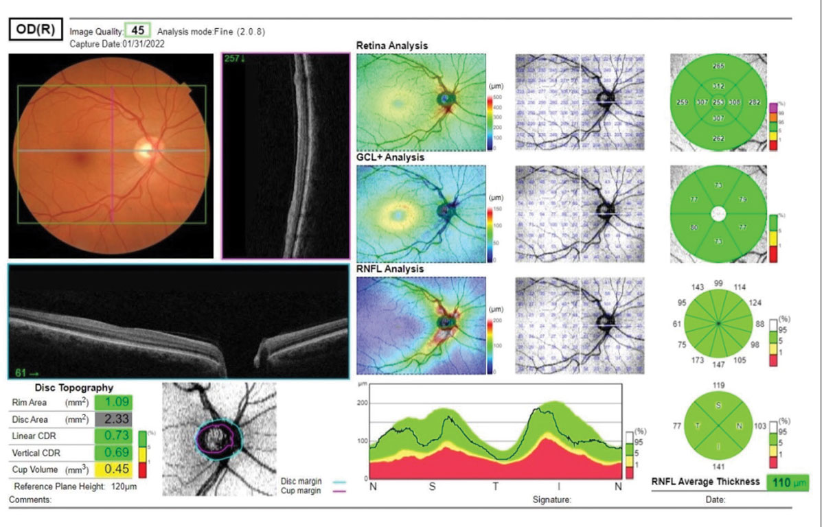 Several metrics are available for evaluation of a glaucoma suspect, including the ganglion cell layer analysis and the RNFL analysis. Also noted are disc topography metrics.