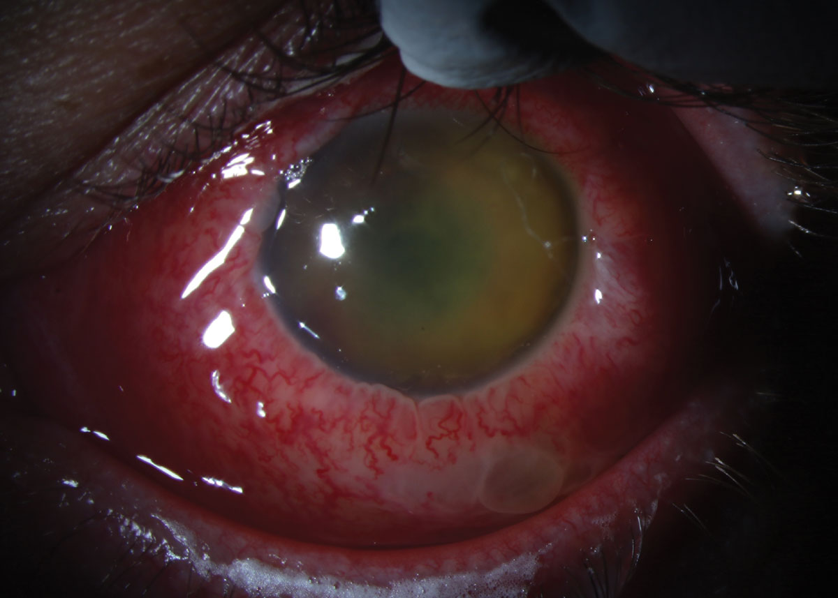 Fig. 3. Slit lamp photograph of the left eye at follow-up after 13 days.