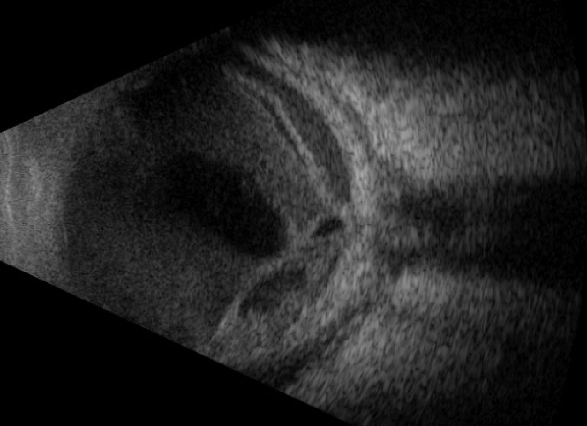 Fig. 4. Vertical axial B-scan over the posterior pole at follow-up after 13 days.