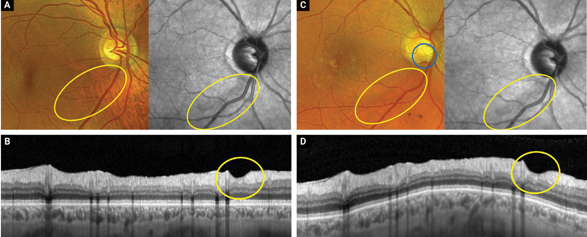 Figures A and B show color, near IR and OCT-B scan images of a glaucomatous inferior temporal wedge (yellow circles) from September 2022. Figures C and D show the same images taken in April of 2023. Note how the disc hemorrhage (blue circle, C) arises within the already present area of tissue loss. This is consistent with the proposed theory that disc hemorrhages are part of the continuum of loss and may not be standalone inciting events.