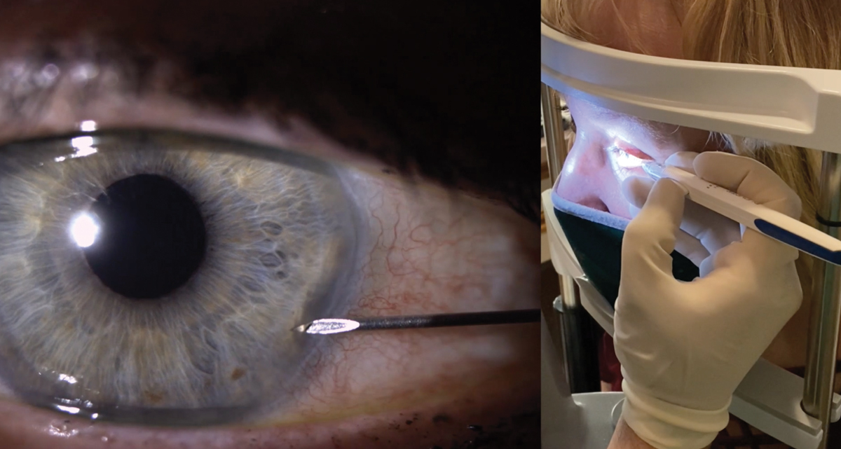 Fig. 1. Proper approach entry of the needle through the cornea. Notice the needle enters through the cornea at approximately the four to five o’clock position in this left eye. Proper hand placement showing stabilization of the hand and fingers on the patient’s face (at right).
