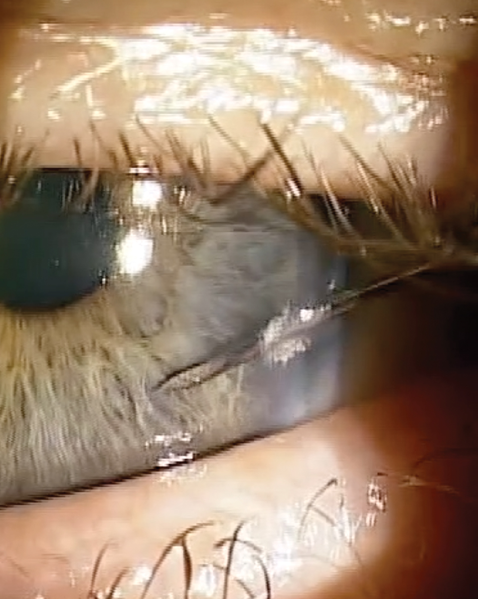 Fig. 3. The needle is now in the anterior chamber at the proper position for insertion of the pellet, about two bevel lengths into the anterior chamber. Notice how the needle is properly placed in front of the iris.