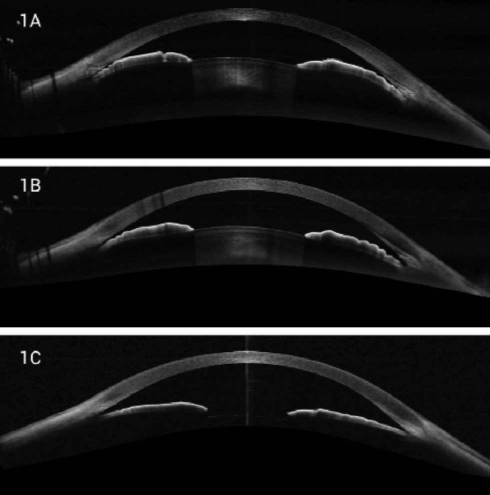 Fig. 1. (A) Edge-to-edge OCT image of narrow angle with iridotrabecular contact. (B) OCT image of same eye after LPI. Note the angle slightly more open. (C) OCT of same image after cataract extraction. Note the flattened iris position with significant angle opening.