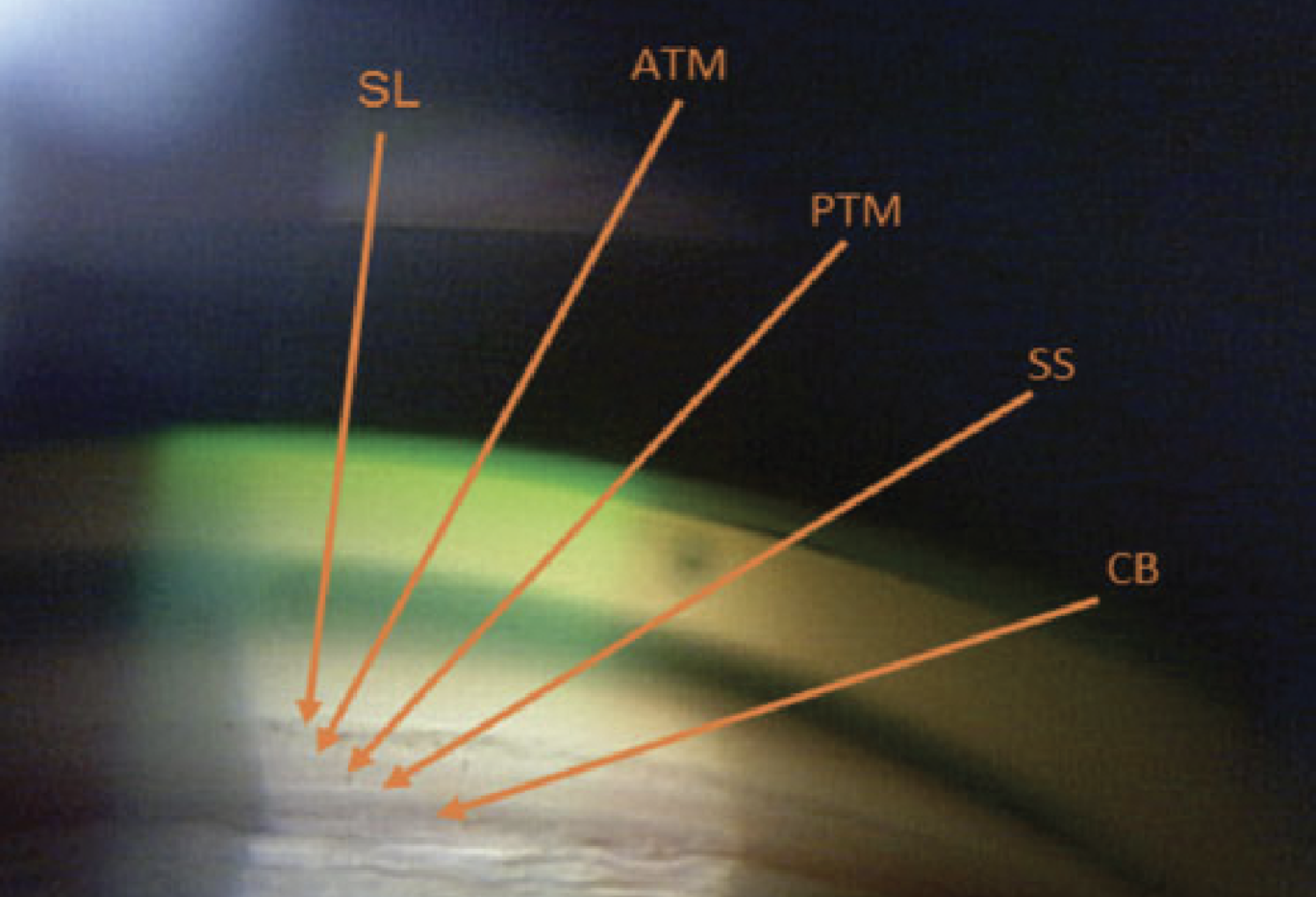Fig. 2. The ciliary body is the most posterior structure visible, followed by the scleral spur, posterior TM, anterior TM and, finally, Schwalbe’s line.