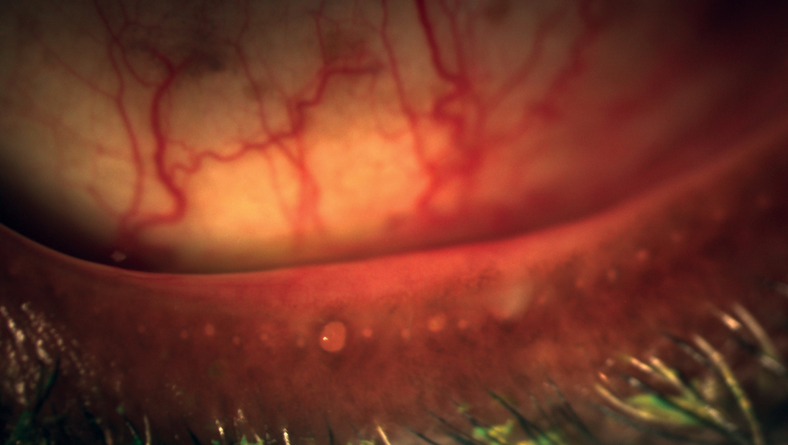 Antibiotics treat meibomian gland dysfunction by altering the eyelid microbiome. Understanding the microbiota of a healthy eye may help to improve disease diagnosis and personalized treatment approaches.