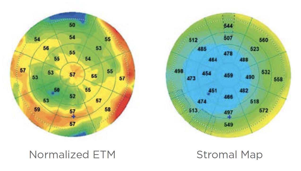 When compared with the Belin ABCD staging system, a newly developed OCT-based system that uses both epithelial (left) and stromal (right) thickness mapping showed staging agreement in 85% of normal cases and between 47% and 77% of keratoconus cases. 