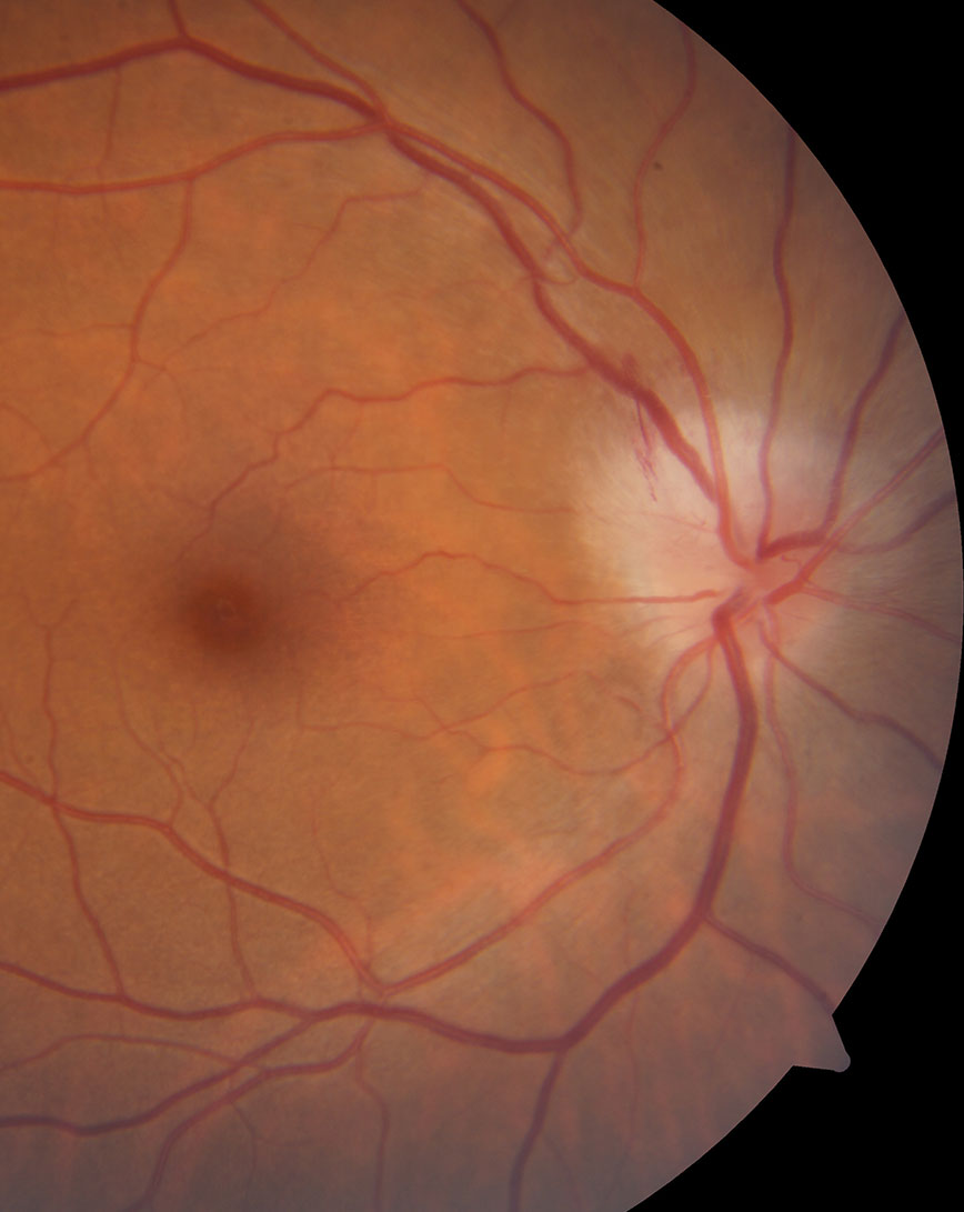 Creating hospital protocols for neuro-ophthalmologic conditions like TIA-related transient vision loss, acute central retinal artery occlusion, papilledema and optic neuritis (pictured) could streamline management of complex patients. 