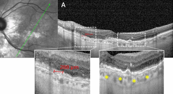 While subclinical angioid streaks and AMD share some differences in pathogenesis, their shared features and high prevalence in the AMD population warrant consideration for angioid streaks as an AMD phenotype. The above images from the study show Bruch’s membrane dehiscences (a; red line), breaks (b; yellow triangles) and undulations (a, b; yellow asterisks).