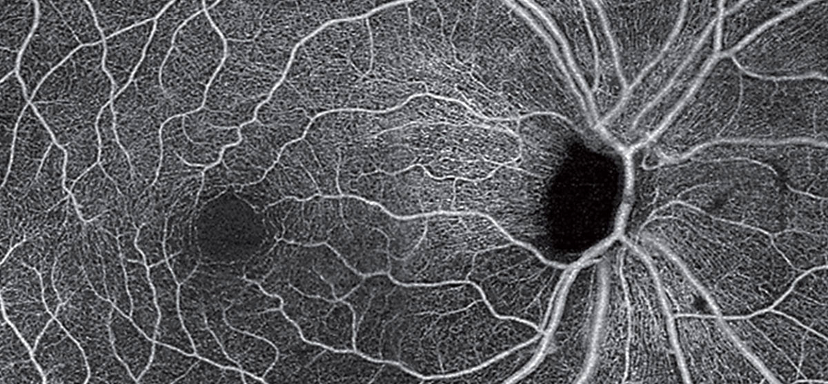 Parkinson’s may be linked to the eye through cerebrovascular changes affecting different retinal layers. This OCT-A montage of an unrelated patient (with POAG) shows loss of radial peripapillary capillaries and the superficial capillary plexus.