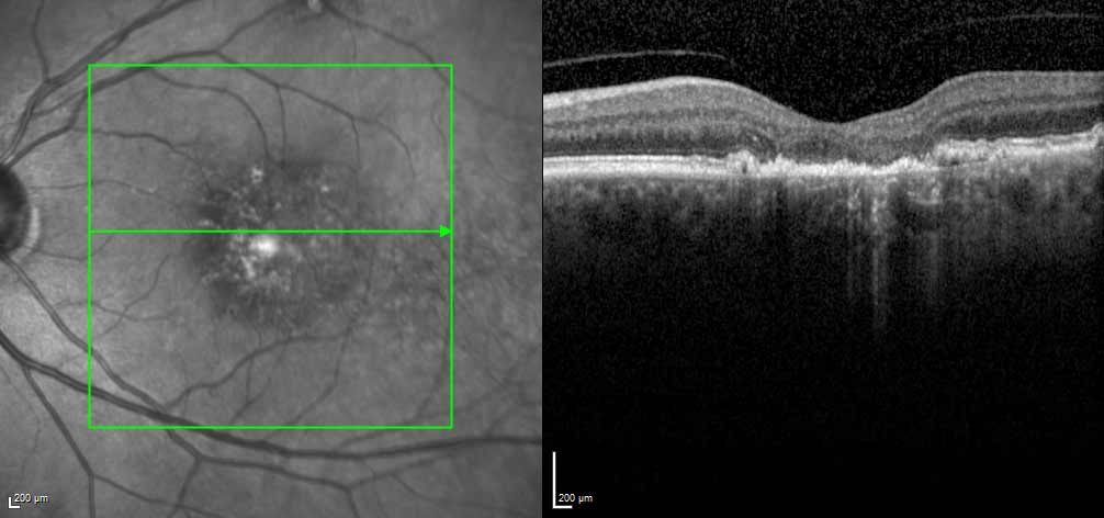 Since macular atrophy progresses faster in dry AMD eyes, it’s possible that neovascularization may play a protective role in macular atrophy growth. 