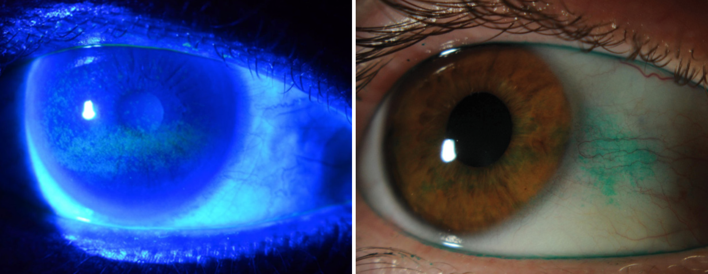 Clinicians will get more true-to-life assessments of presumed dry eye by using a range of tests, with special attention to staining patterns.