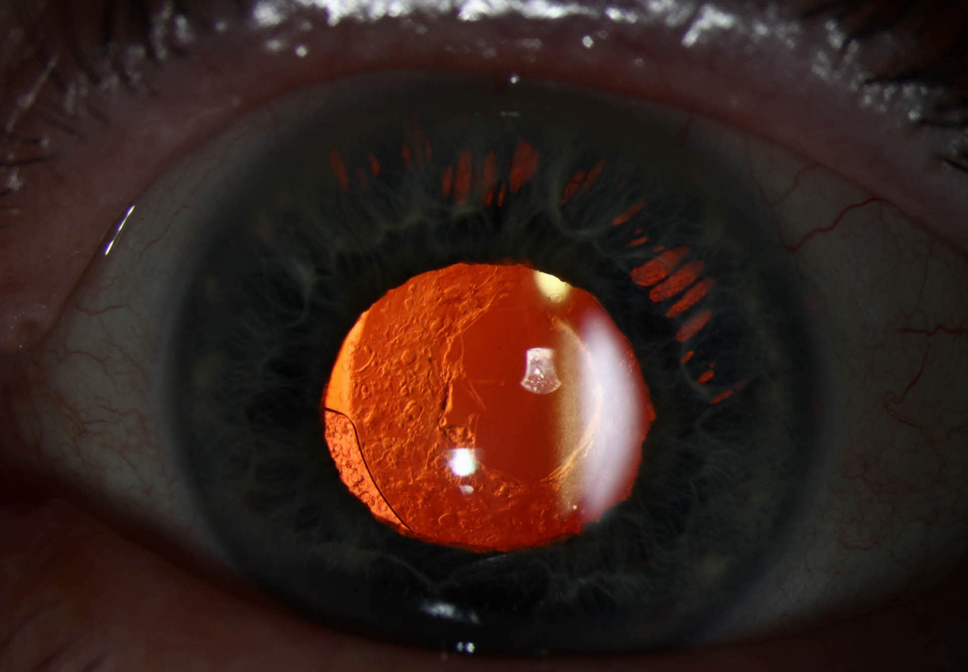This study noted an average improvement in vision from 20/41 at baseline to 20/23 at three weeks post-op in patients who underwent optometrist-performed YAG capsulotomy.