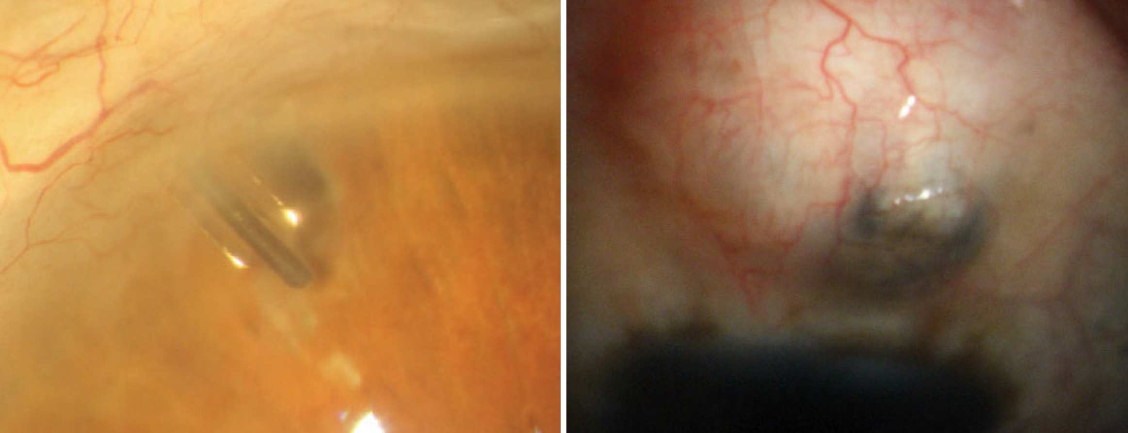 Tube shunt use (left) for advanced glaucoma reduced IOP by 12.3mm Hg in one year while trabeculectomy (right) lowered it by 11.8mm hg, a recent data analysis shows.