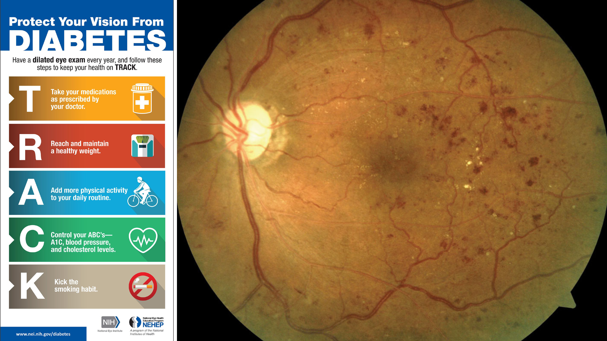 It is crucial that all adults with diabetes have regular diabetic retinopathy surveillance exams to decrease their likelihood of worsening eye health and progression to vision-threatening diabetic retinopathy and/or diabetic macular edema.