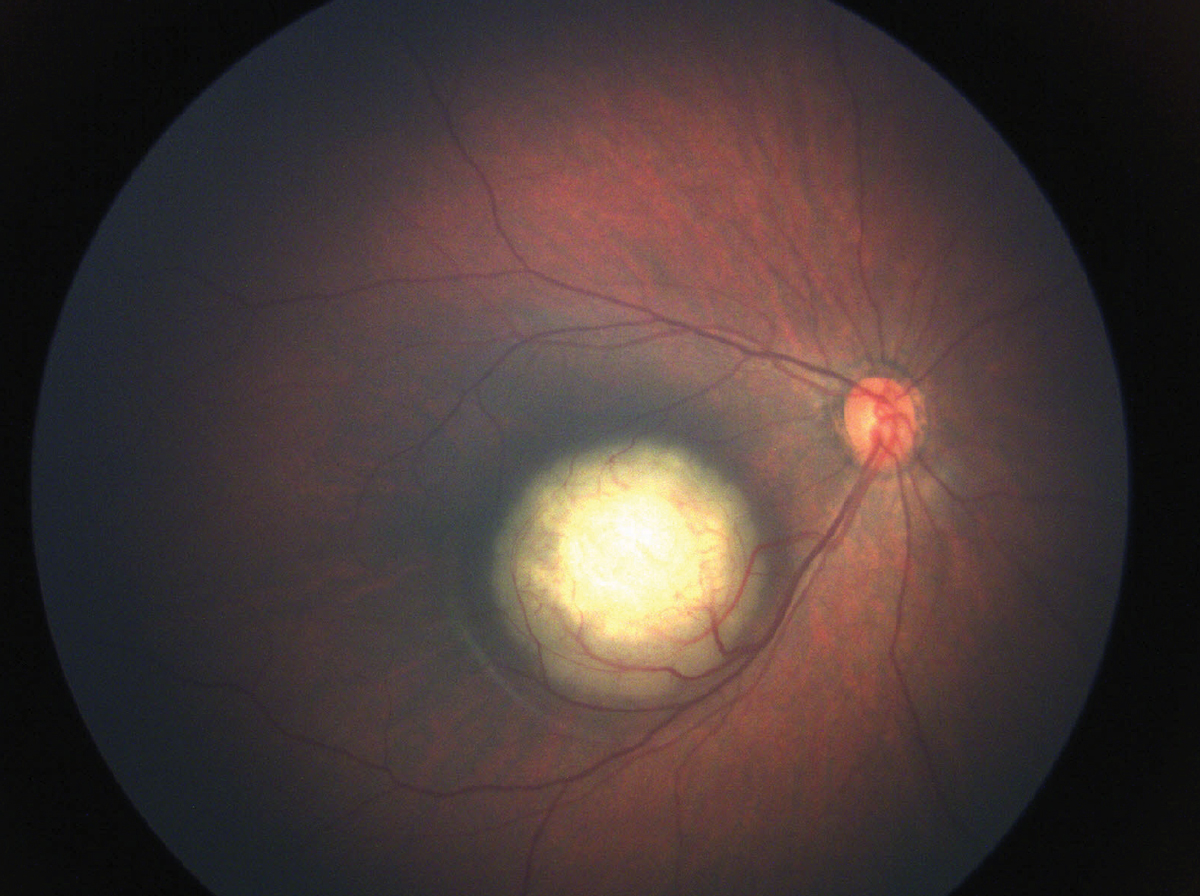Right eye from a different patient with a retinoblastoma within the arcades and impinging on the fovea. Since the lesion includes the fovea, the axial length will decrease and the refractive error will become more hyperopic. Like the case in question, there was no retinoblastoma in the fellow eye and hence, the anisometropia will increase.