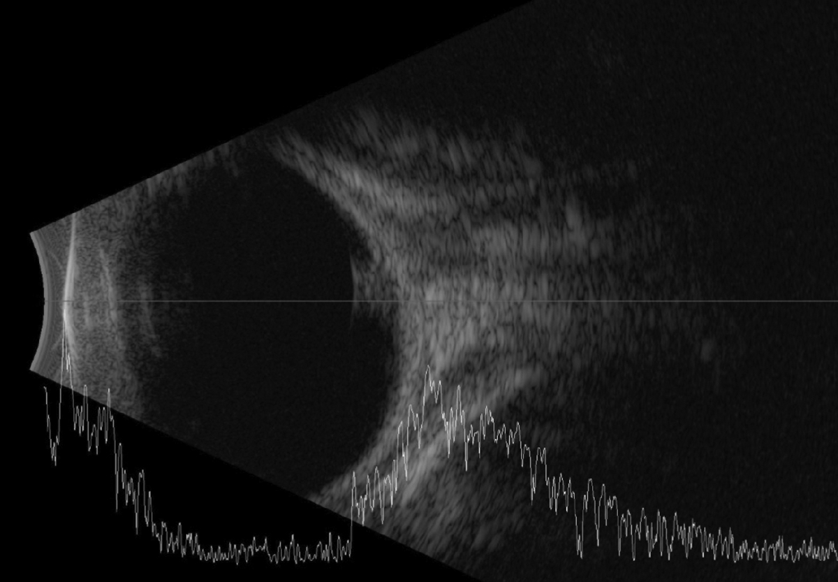 The B-scan reveals a mass in the posterior pole and close to the optic nerve head.
