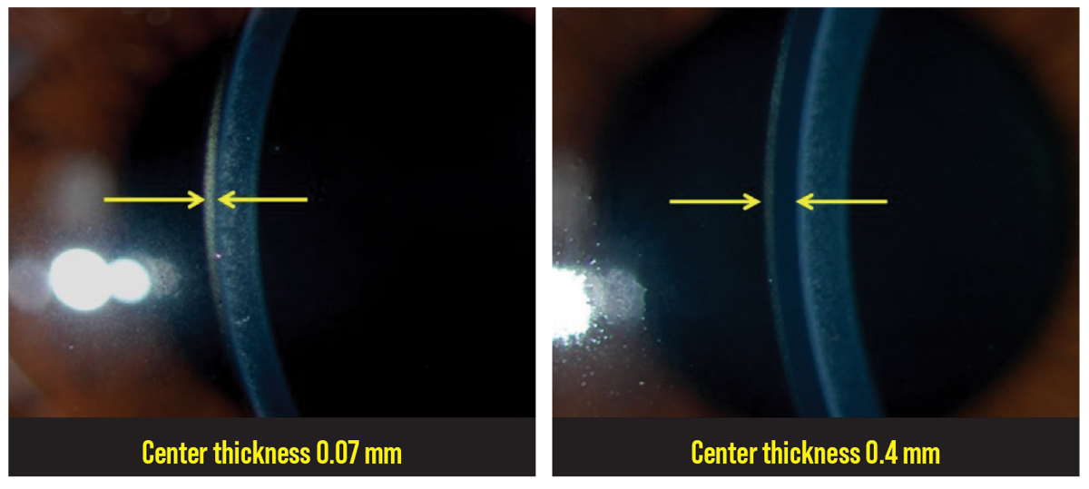 Fig. 5. Custom soft lenses can be used in patients who have irregular astigmatism due to the increased central thickness of the lens. 