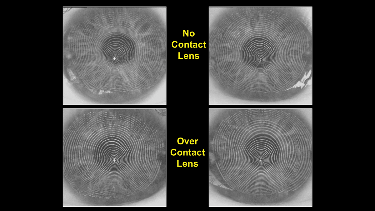 Fig. 6. Videokeratoscopy helps demonstrate how custom soft lenses can be used for irregular astigmatism.