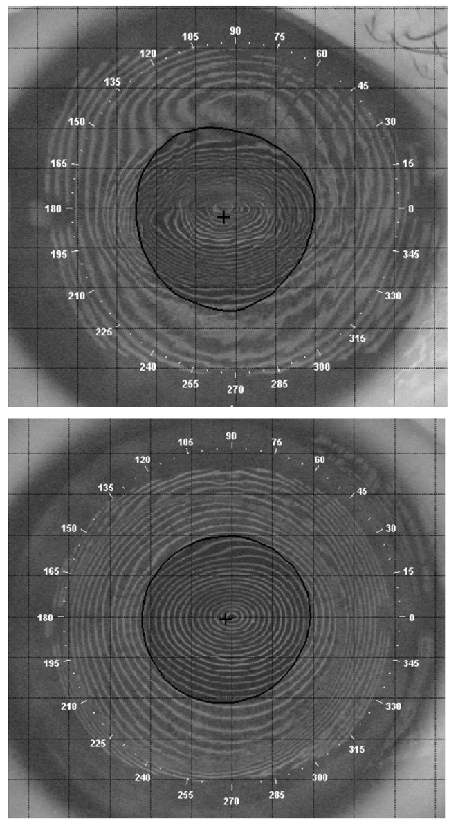 Fig. 7. The thickened contact lens, as seen with topography, converts irregular astigmatism to be more regular in nature, and the necessary toric lens power can be placed on the front surface of the contact lens to optimize the patient’s vision.