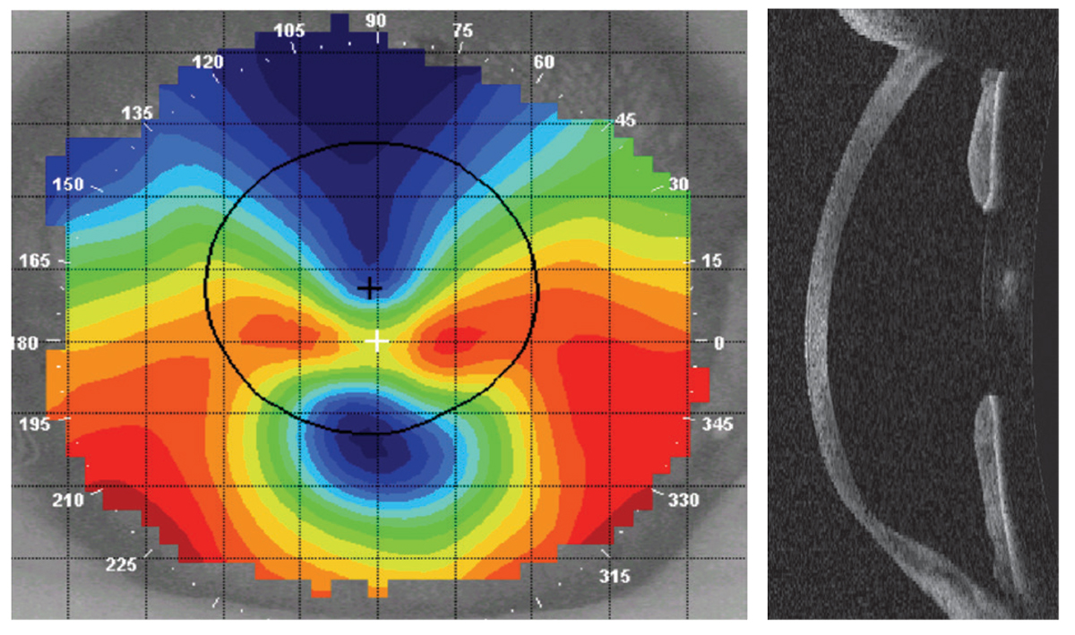Fig. 10. A corneal topographer helps demonstrate that, though the amount of against the rule astigmatism present in the central cornea is high in a patient with pellucid marginal degeneration, it is often regular over the pupil and visual axis.