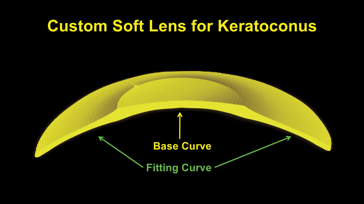 Fig. 9. The central base curve and the fitting curve make up the design of a custom soft lens for keratoconus.