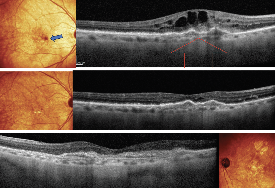 OD fundus exam shows small subretinal hemorrhage (blue arrow) and OCT (top) is remarkable for choroidal neovascularization (CNV), as shown with red arrow. OS has a large disciform scar (bottom image). Patient received an intravitreal injection of Vabysmo. At one month follow-up, regression of CNV was noted (middle image) and VA has improved to 20/30. At this time, patient receives her second injection, with her next appointment set for three months.