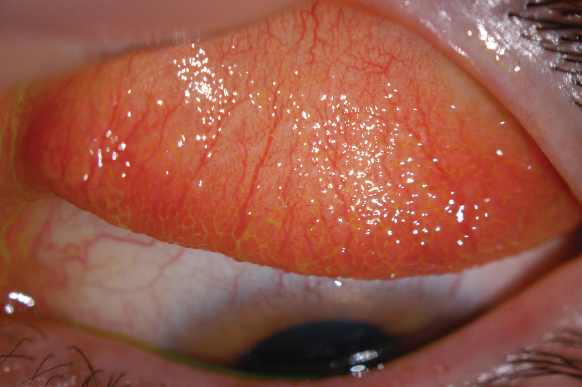Fig. 2. Inflamed superior conjunctiva with papillary reaction (GPC).