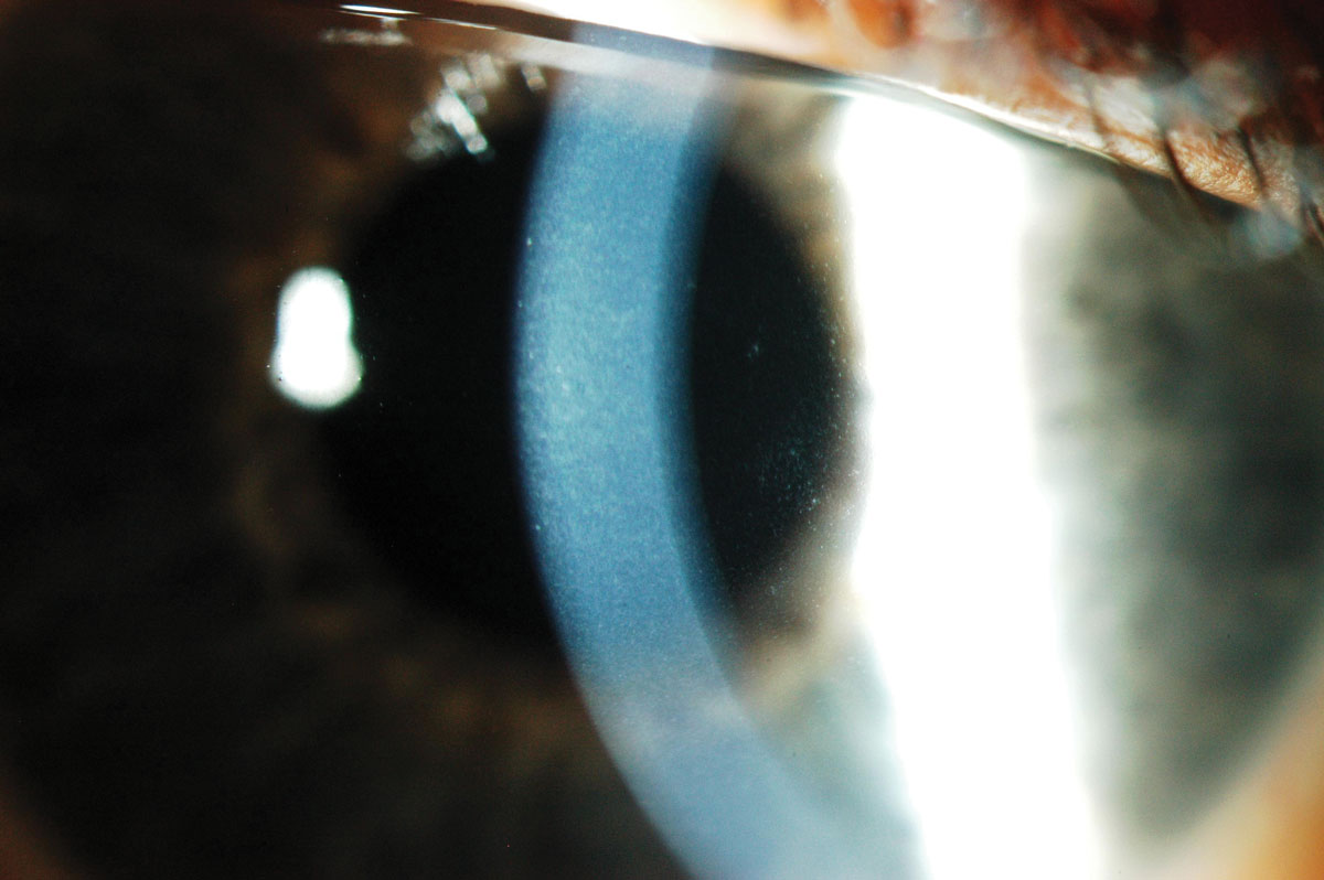 Fig. 5. Corneal edema and microcysts following extended wear with low Dk lenses.