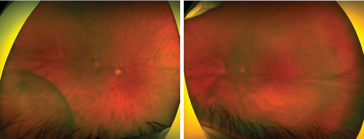 Figs. 1 and 2. Optos widefield fundus photography of the right eye (left) and left eye (right).