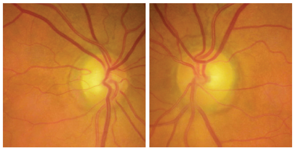 Fig. 1. Optic disc photos demonstrating subtle superotemporal optic disc pallor of both eyes.
