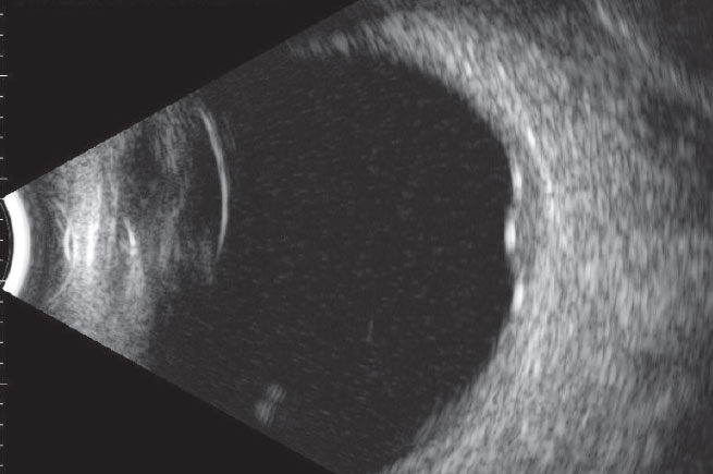 Does this ultrasonography scan confirm any suspicions raised by the findings shown in the fundus photo?