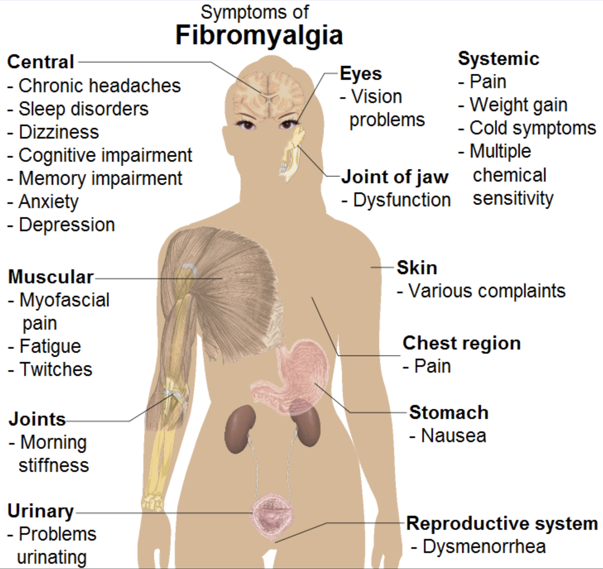 Fibromyalgia and optic neuritis likely share a pathophysiology of autoimmunity-related neuroinflammation.