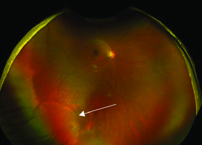 UWF imaging is capable of detecting retinal tears and holes but some may be missed without acquiring additional photos at different angles, the study found.
