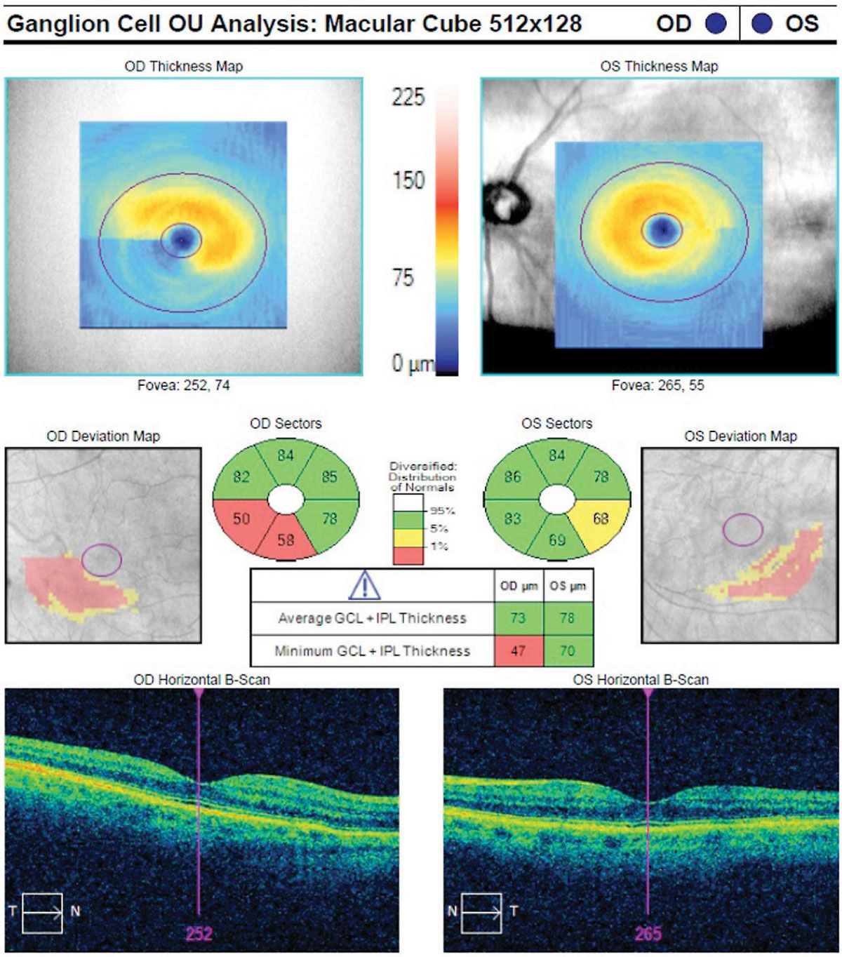 While the study did not find a significant cross-sectional difference in GC-IPL thickness between patients with Parkinson’s and control patients, those with the condition had a significantly greater rate of GC-IPL thinning over time. (Image shows GC-IPL thinning in a glaucoma patient.)