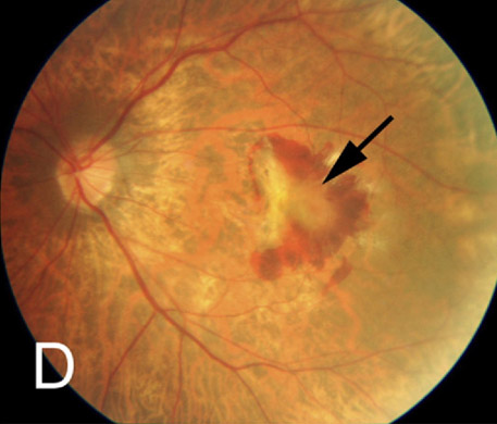 A macular hemorrhage and fibrovascular membrane (arrow) in a 67-year-old -10.50D myopic woman.