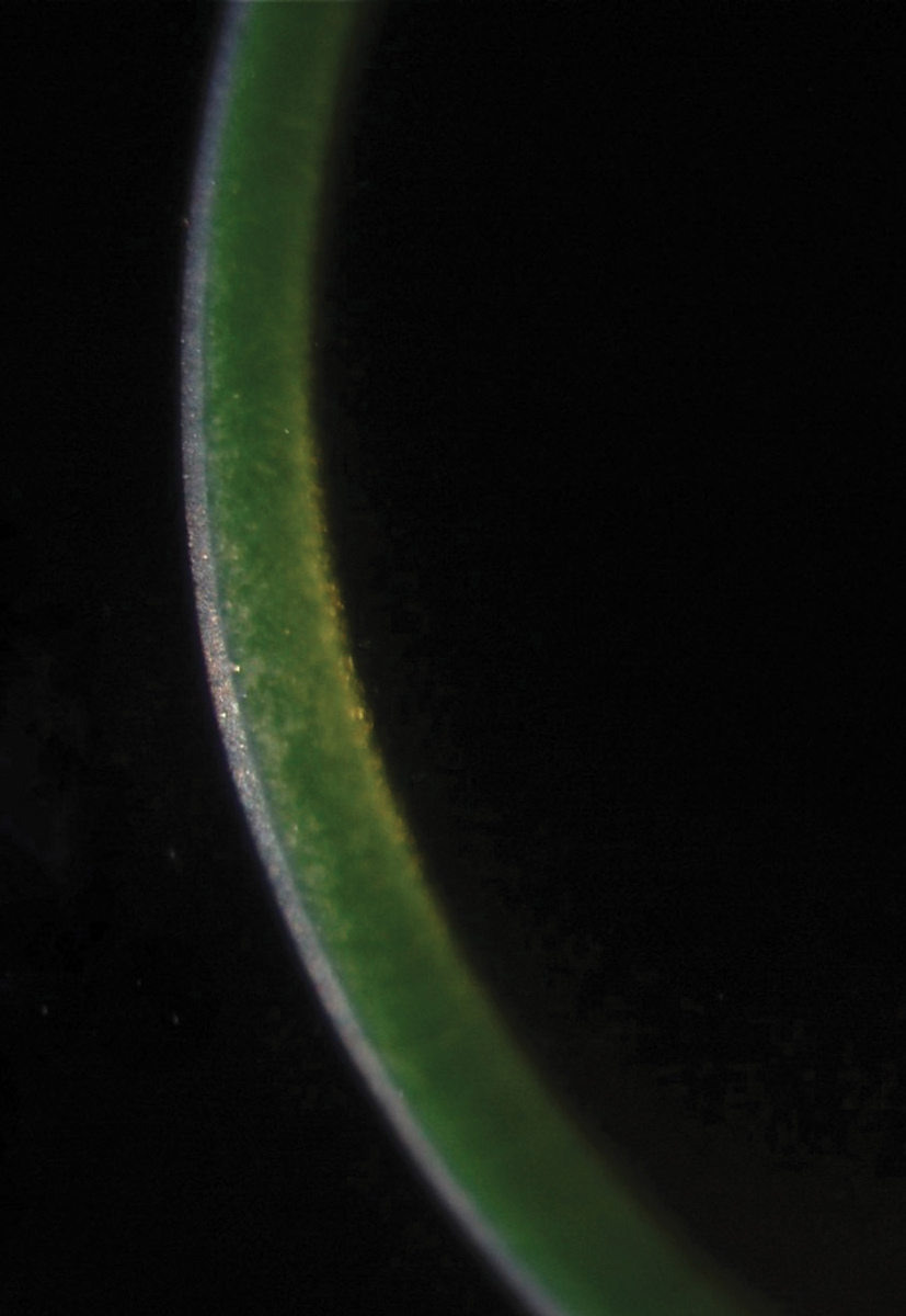 The green glow of riboflavin indicates adequate penetration into the corneal stroma prior to collagen crosslinking.