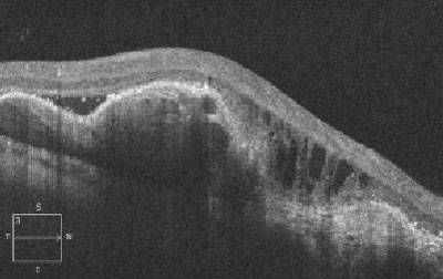 In addition to using indocyanine green angiography, observing polypoidal lesions on OCT over time may help assess the risk for exudative conversion in patients with non-exudative polypoidal choroidal vasculopathy.