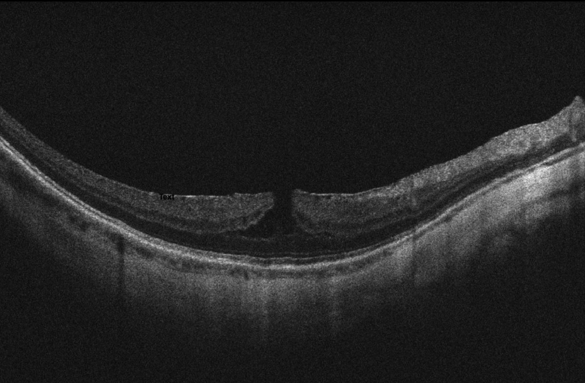 Quantitative choroidal assessment can be used to categorize high myopes into three subgroups: high myopia without complications, with MNV or with macular or posterior pole atrophy. The MNV subgroup is characterized by intermediate choroidal thinning and a higher prevalence of round dome-shaped macula with sub-dome choroidal deepening.