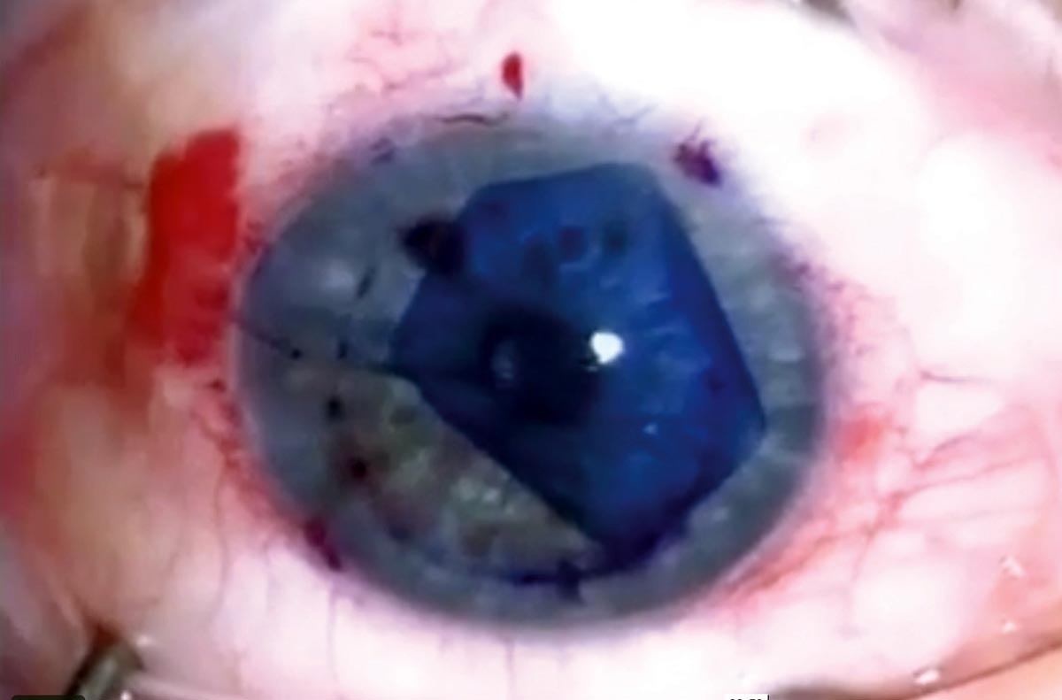 Fuchs’ dystrophy patients with bilateral DMEK achieved sustainable outcomes until at least five years after the second surgery, and the same complications may rarely occur in both eyes.
