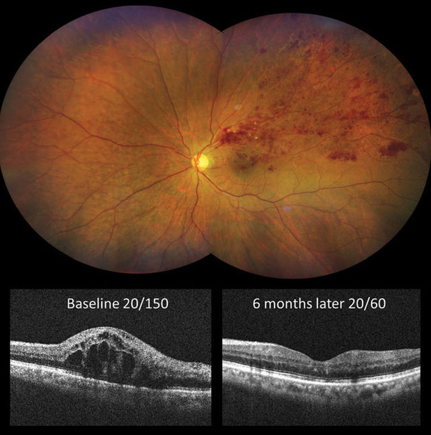 Introducing anti-VEGF treatment with attention to the presence of recurrent serous retinal detachment can help to optimize BVO-ME patients’ visual outcomes.