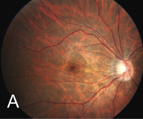 Fundus tessellation is a subtype of myopic maculopathy characterized by enlarged choroidal vessels around the fovea with thinning of the retinal epithelium and choriocapillaris.